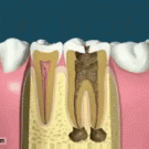 Root canal and crown prep procedure