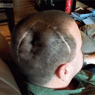Guy blows up hole in his head
